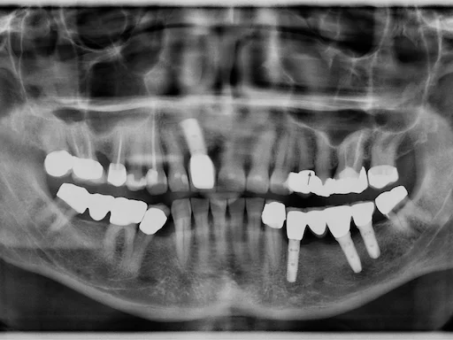 Patientenfall: Zähne 44,45,46,48 - Röntgenaufnahme