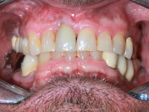 Patientenfall: Zähne 44,45,46,48 - Ausgangssituation