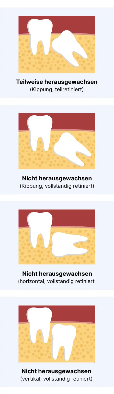 Vier abstrahierte Grafiken mit typischen Lagevariationen von Weisheitszähnen im Kiefer. Dargestellt sind jeweils zwei nebeneinanderliegende Zähne, bei denen der jeweils rechts liegende Zahn einen Weisheitszahn repräsentiert. Der Kieferknochen ist gelb gefärbt, das Zahnfleisch hellrot, der Mundraum im Hintergrund dunkelrot. Bild 1: Der Weisheitszahn ragt leicht über das Zahnfleisch hinaus und liegt etwa in einem 40 Grad Winkel gegen den Uhrzeigersinn geneigt im Kieferknochen. Die Beschriftung lautet: Teilweise herausgewachsen (Kippung, teilretiniert) Bild 2: Der Weisheitszahn ist komplett im Kieferknochen eingeschlossen, jedoch im 40 Grad Winkel gegen den Uhrzeigersinn geneigt. Die Beschriftung lautet: Nicht herausgewachsen (Kippung, vollständig retiniert) Bild 3: Der Weisheiheitszahn ist komplett im Kieferknochen eingeschlossen, dabei jedoch um 90 Grad gegen den Uhrzeigersinn geneigt. Die Beschriftung lautet: Nicht herausgewachsen (horizontal, vollständig retiniert) Bild 4: Der Weisheitszahn ist komplett im Kieferknochen eingeschlossen, mit minimaler Drehung. Die Beschriftung lautet: Nicht herausgewachsen (vertikal, vollständig retiniert)