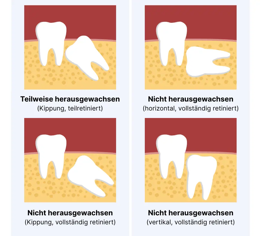 Vier abstrahierte Grafiken mit typischen Lagevariationen von Weisheitszähnen im Kiefer. Dargestellt sind jeweils zwei nebeneinanderliegende Zähne, bei denen der jeweils rechts liegende Zahn einen Weisheitszahn repräsentiert. Der Kieferknochen ist gelb gefärbt, das Zahnfleisch hellrot, der Mundraum im Hintergrund dunkelrot. Oben links: Der Weisheitszahn ragt leicht über das Zahnfleisch hinaus und liegt etwa in einem 40 Grad Winkel gegen den Uhrzeigersinn geneigt im Kieferknochen. Die Beschriftung lautet: Teilweise herausgewachsen (Kippung, teilretiniert) Oben rechts: Der Weisheiheitszahn ist komplett im Kieferknochen eingeschlossen, dabei jedoch um 90 Grad gegen den Uhrzeigersinn geneigt. Die Beschriftung lautet: Nicht herausgewachsen (horizontal, vollständig retiniert) Unten links: Der Weisheitszahn ist komplett im Kieferknochen eingeschlossen, jedoch im 40 Grad Winkel gegen den Uhrzeigersinn geneigt. Die Beschriftung lautet: Nicht herausgewachsen (Kippung, vollständig retiniert) Unten rechts: Der Weisheitszahn ist komplett im Kieferknochen eingeschlossen, mit minimaler Drehung. Die Beschriftung lautet: Nicht herausgewachsen (vertikal, vollständig retiniert)