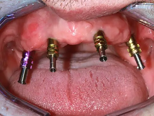 Oberkieferkamm nach der Einheilung mit gesetzten Implantataufbauten