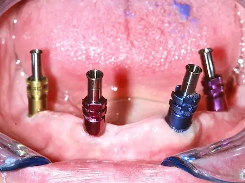 Unterkieferkamm nach der Einheilung mit gesetzten Implantataufbauten
