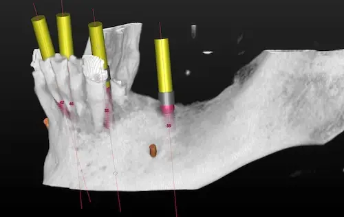 3D-Planung im Unterkiefer mit vier Implantaten - Ansicht von der Seite