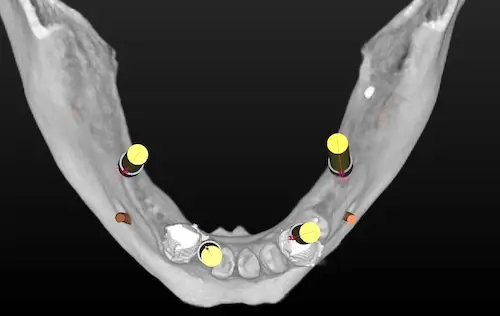 3D-Planung im Unterkiefer mit vier Implantaten - Ansicht von oben