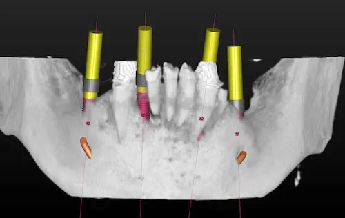 3D-Planung im Unterkiefer mit vier Implantaten - Ansicht von vorne