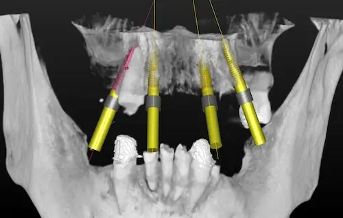 3D-Planung im Oberkiefer mit vier Implantaten - Ansicht von vorne
