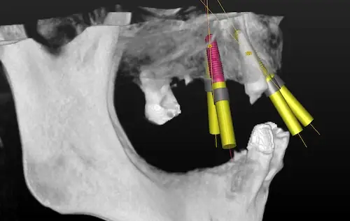 3D-Planung im Oberkiefer mit vier Implantaten - Ansicht von der Seite