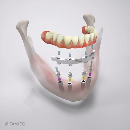 Camlog - All-on-4 - Digitales Rendering einer AO4-Steg-Versorgung im Unterkiefer mit Detailansichten der einzelnen Bestandteile