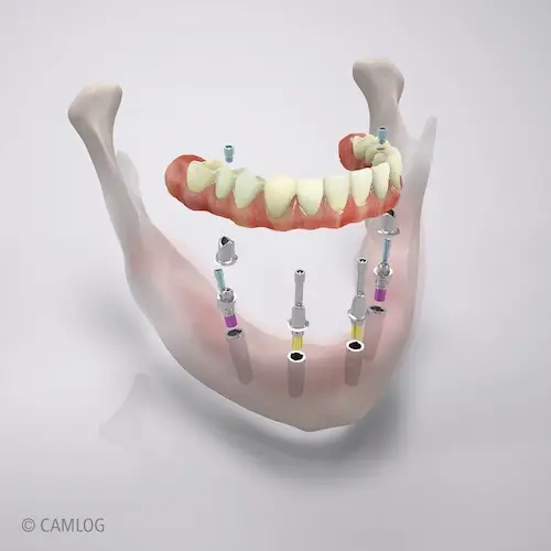 Camlog - All-on-4 - Digitales Rendering einer AO4-Teleskop-Versorgung im Unterkiefer mit Detailansichten der einzelnen Bestandteile