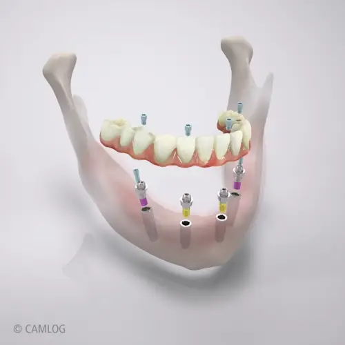 Camlog - All-on-4 - Digitales Rendering einer AO4-Versorgung im Unterkiefer mit Detailansichten der einzelnen Bestandteile