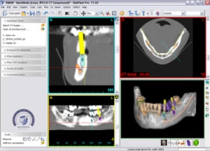 3d Diagnostik Röntgenbild - Implantatplanung