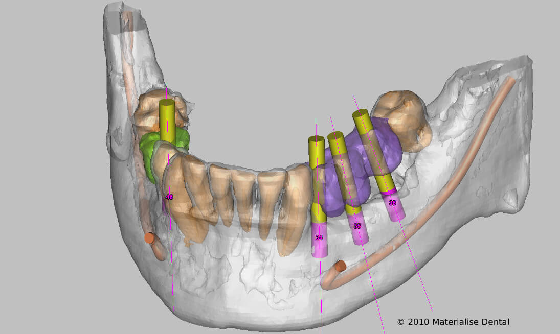 3d Ansicht eines Unterkiefers zur Planung von 4 Implantat