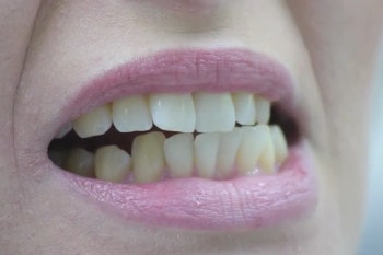 CMD Test 8: Zähne abgenutzt?