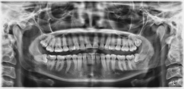 Weisheitszahn-OP: Röntgenbild - Lage von Weisheitszähnen im Kiefer - Beispiel 2