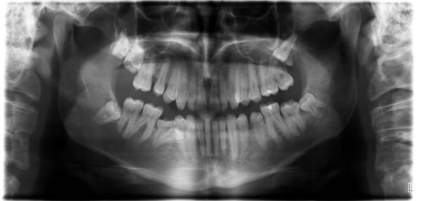 Weisheitszahn-OP: Röntgenbild - Lage von Weisheitszähnen im Kiefer - Beispiel 1