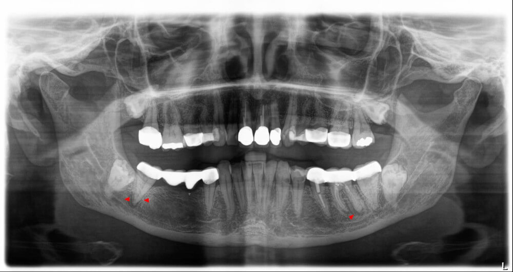 Weisheitszahn-OP: Röntgenbild - Lage von Weisheitszähnen im Kiefer - Beispiel 3