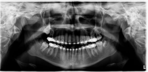 Weisheitszahn-OP: Röntgenbild - Lage von Weisheitszähnen im Kiefer - Beispiel 4