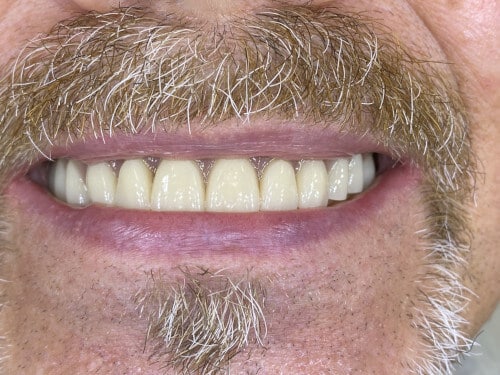 Oberkiefer-Zahnreihe nach erfolgreicher Implantatversorgung mittels All-on-Four