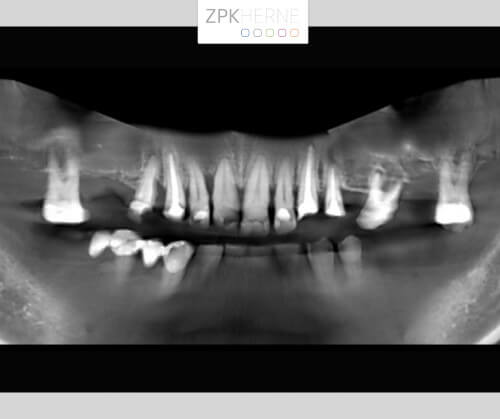 Radiologische Aufnahme der Zahnsituation