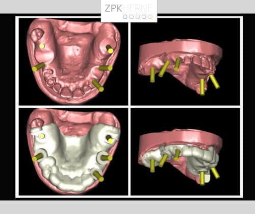 Implantatplanung im Oberkiefer mittels Simplant Software