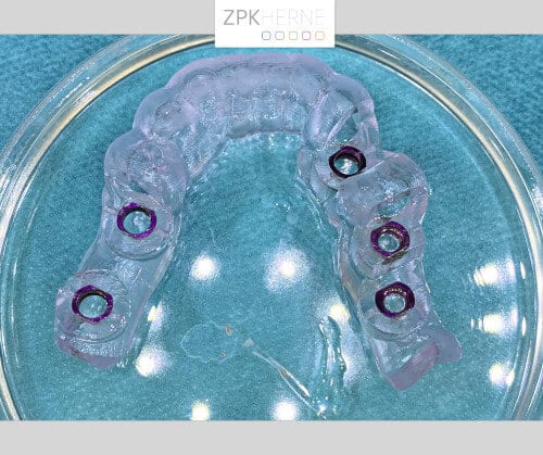 Bohrschablone - 2 Implantate links - 3 Implantate rechts