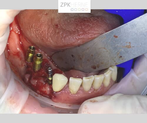 Implantation von 3 Zahnimplantaten im Unterkiefer rechts