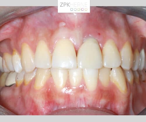 Kieferansicht nach der Implantatbehandlung - Zahn 21