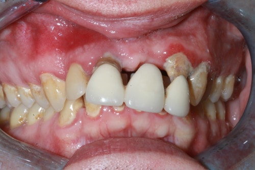 Patientenfall Implantatbrücke - Zahnsituation