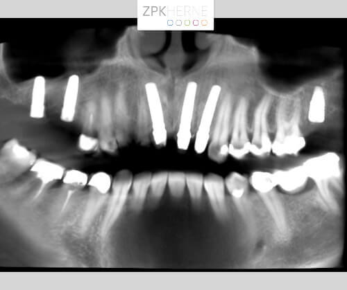 Digitale Volumentomografie mit Zahnimplantaten an Position 11, 21 und 22