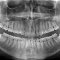digitales röntgen beim zahnarzt in Herne Wanne Eickel