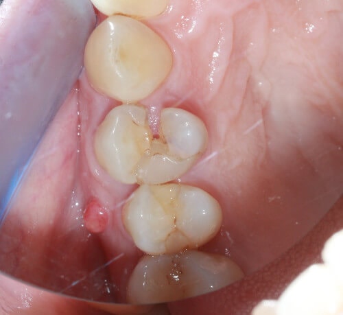 Patientenfall Einzelimplantat - Zahnsituation