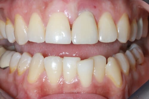Zahnreihe nach Einzelzahnversorgung mittels Implantat im Frontzahnbereich