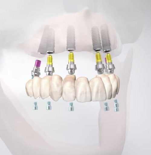 All-on-six: verschraubte Brücke im Oberkiefer auf 6 Implantaten - Schema