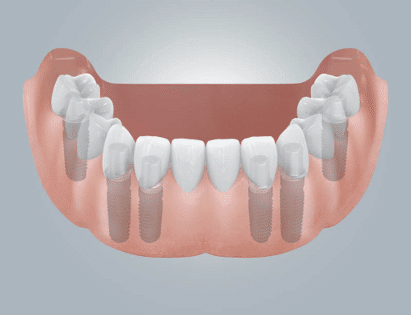 Festsitzender Implantatgetragener Zahnersatz