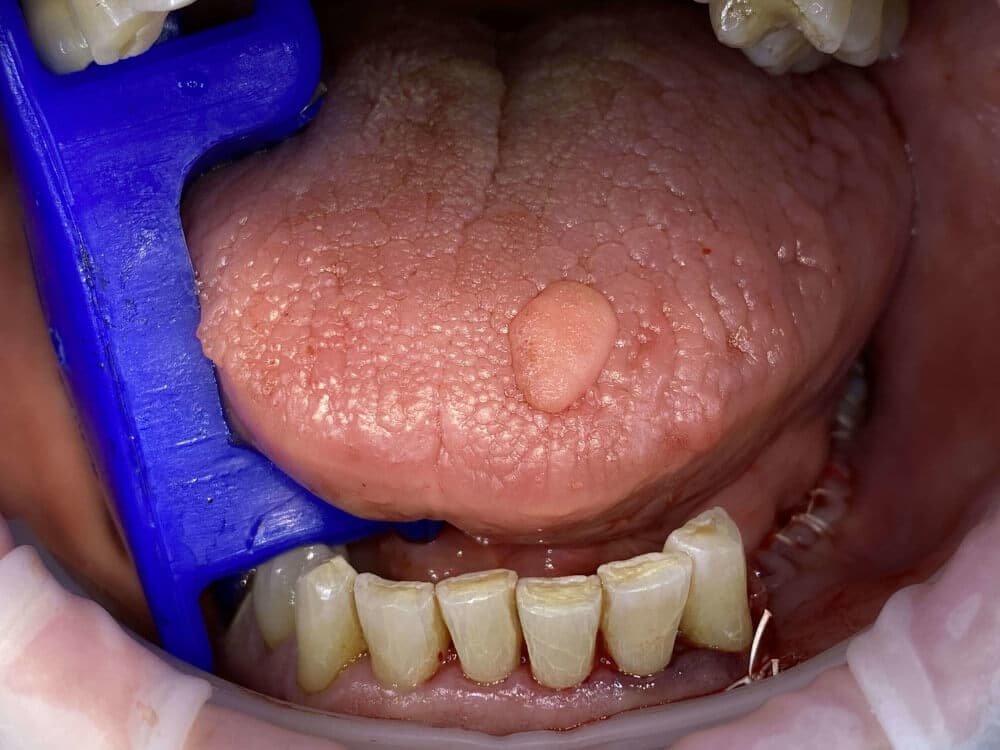 Frontaufnahme eines Zungenfibroms