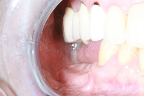 Patientenfall Freinendsituation - Zahnsituation