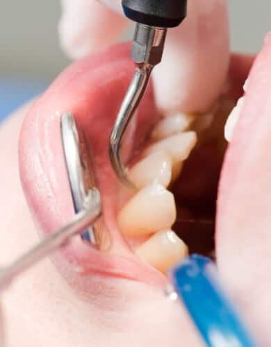 Geschlossene Parodontosebehandlung ohne Operation
