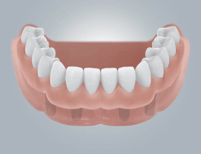 Herausnehmbare Implantatgetragene Zahnprothese