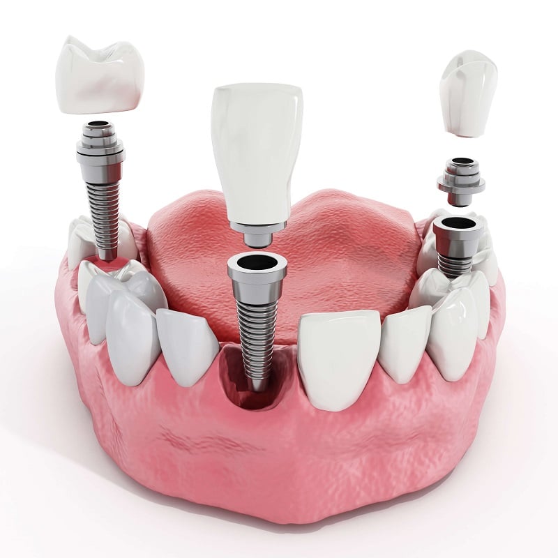 Ansicht der einzelnen Zahnimplantat-Bestandteile (Implantatkörper, Abutment, Krone) in einem Gebiss
