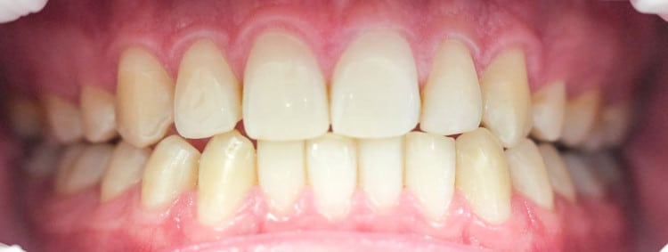 Gebiss nach Frontzahn-Derotation und Harmonisierung der Zahnkurve durch Invisalign Zahnschienen