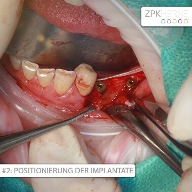 Positionierung der Implantate