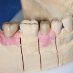 Labor Zahnprothetik Zahnersatz Herstellung Keramik Backenzähne