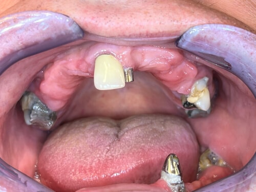 Patientenfall: Locatoren - Zahnsituation