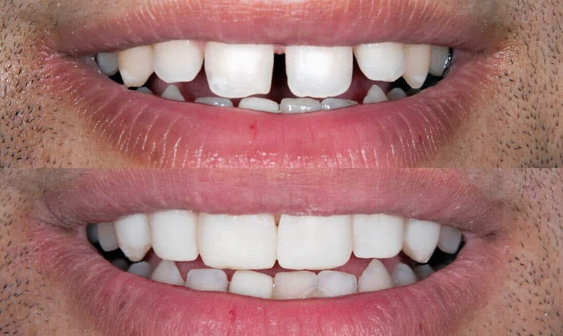 Vorher-Nachher-Vergleich nach einer Behandlung einer Lücke zwischen den Schneidezähne schliessen