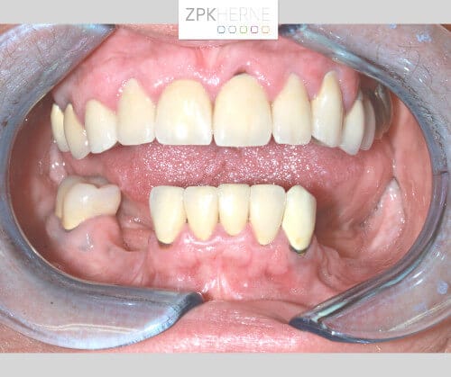 Frontalansicht Ober- und Unterkiefer mit verkürzter Zahnreihe und Schaltlücke