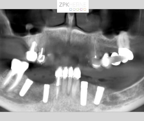 Röntgenaufnahme zur Kontrolle der vier gesetzten Implantate