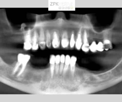 Röntgenaufnahme der Kiefersituation: Verkürzte Zahnreihe, Schaltlücke, Knochenabbau