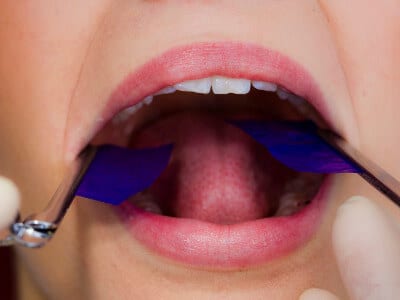 Okklusion Diagnostik Kontaktpunkte der Zähne