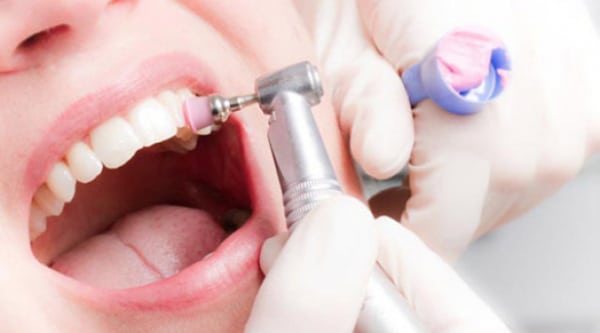 Zähne werden mit Polierpaste und Handinstrument poliert