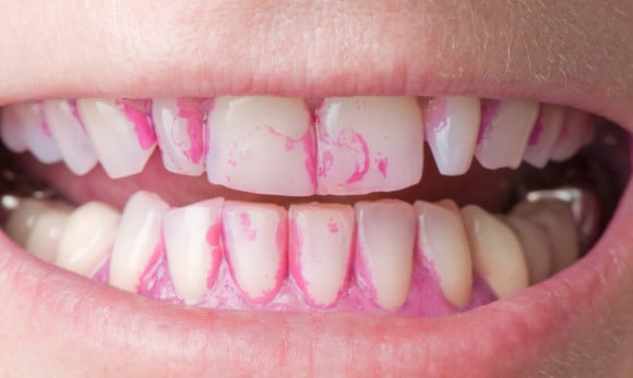 Zahnbelag durch Plaque-Färbetabletten sichtbar gemacht